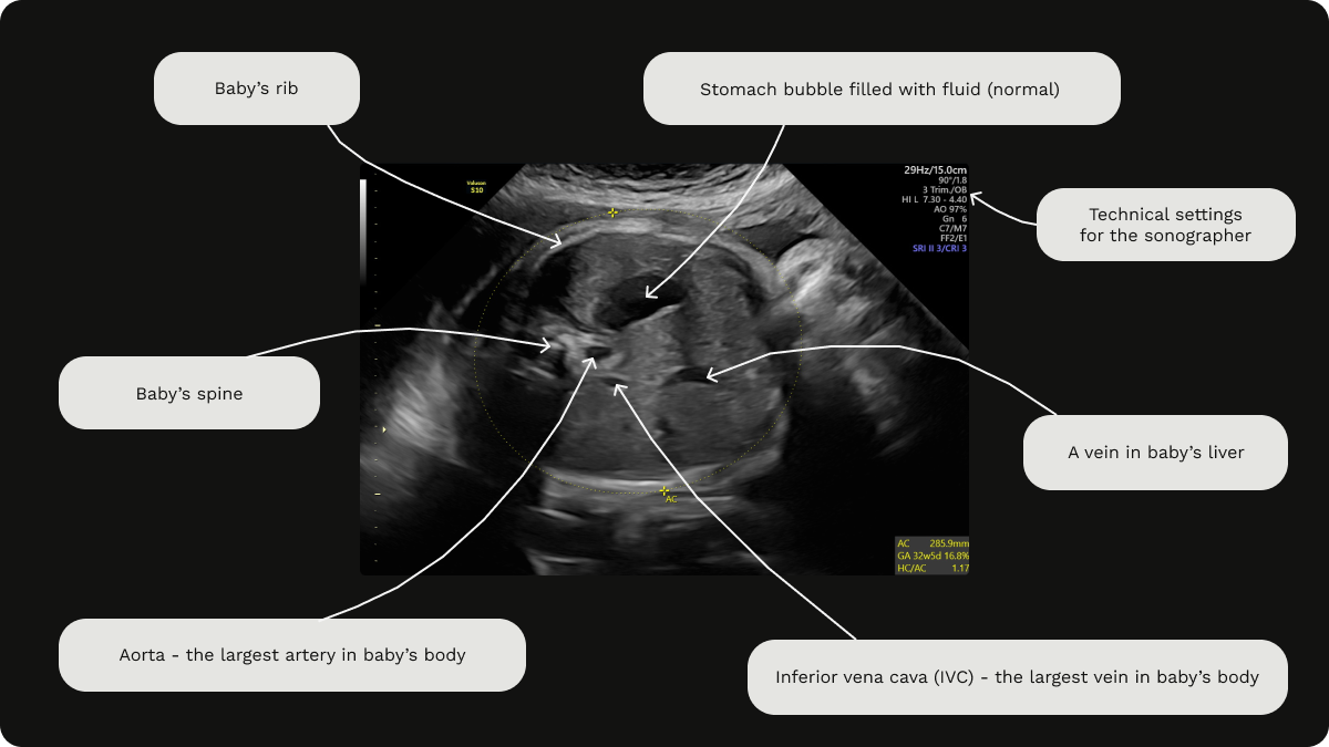 Labelled image of a growth scan at 32 weeks gestation, including abdominal circumference (AC) measurement.
