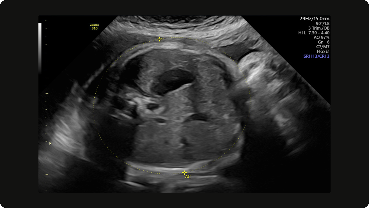 Abdominal circumference (AC) on a growth scan at 32 weeks gestation.