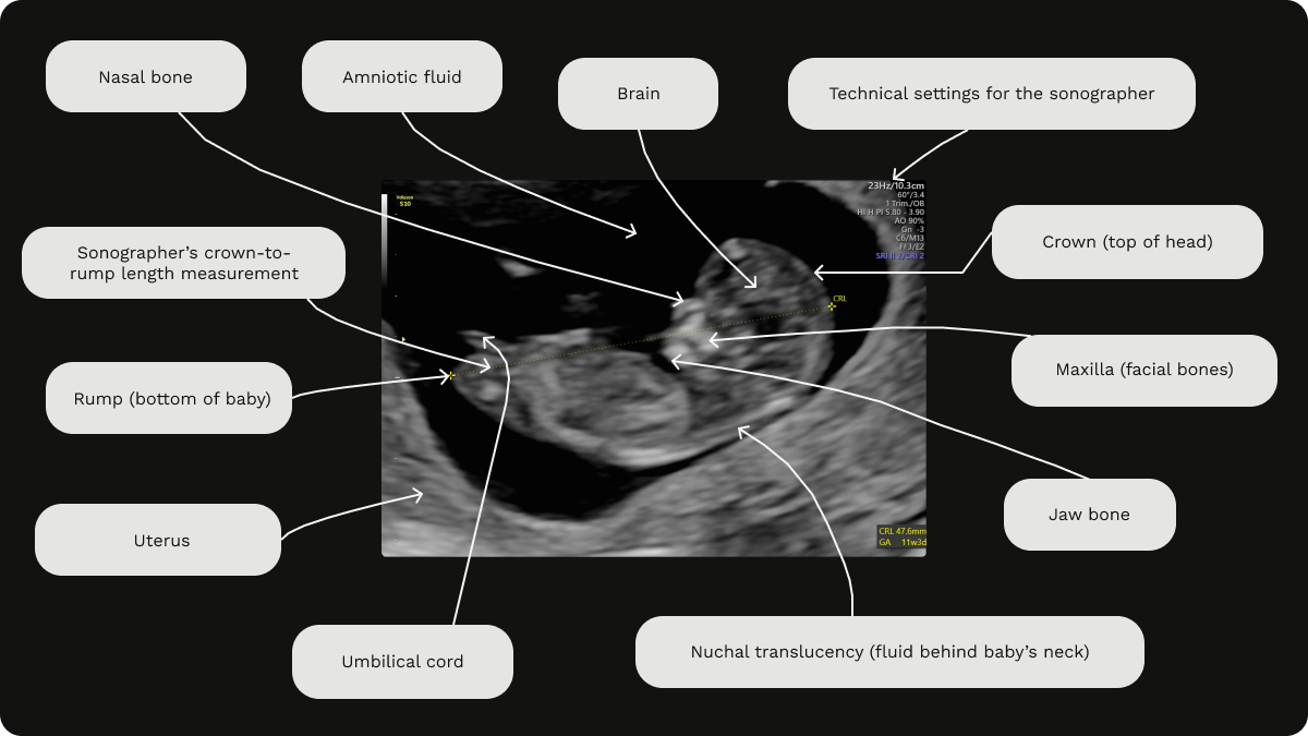 Labelled early pregnancy scan image at 11 weeks gestation showing crown-to-rump length (CRL) and other features