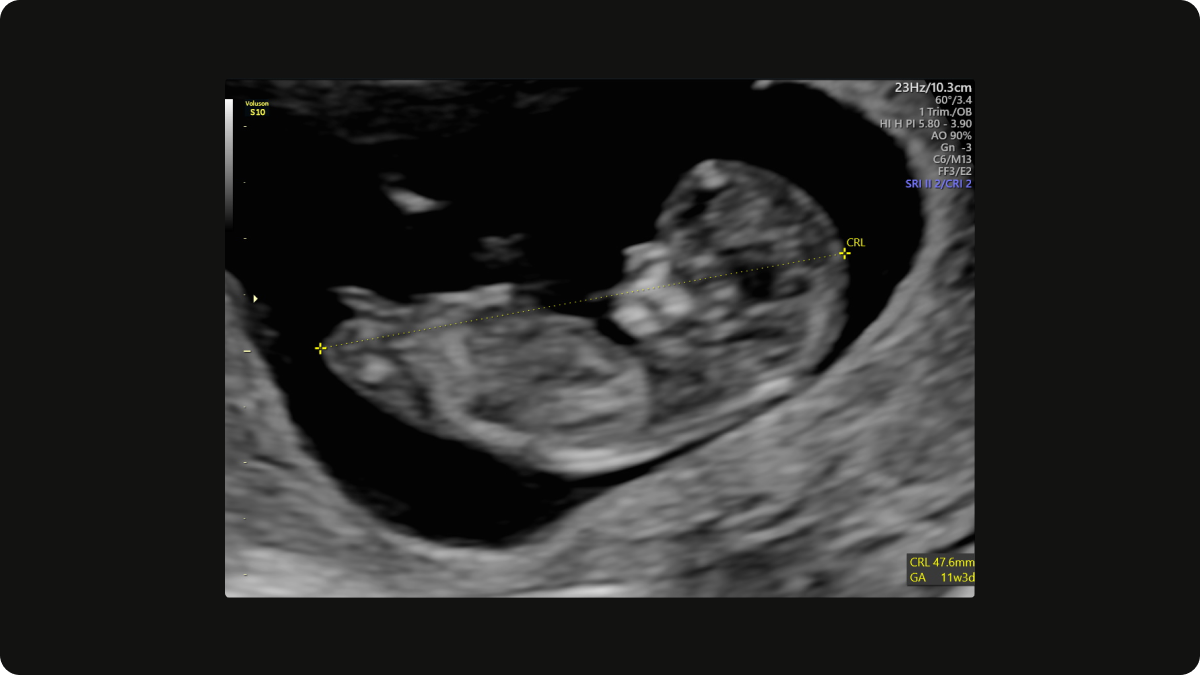 Crown-to-rump length (CRL) on an early pregnancy scan at 11 weeks gestation