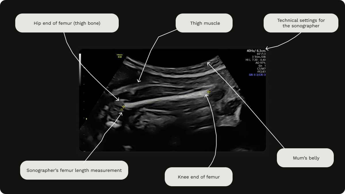 Labelled image of a growth scan at 28 weeks gestation, including a femur length (FL) measurement.
