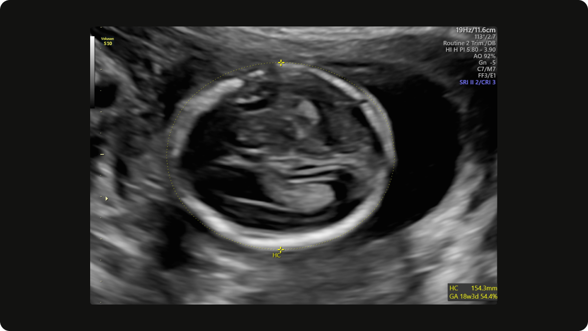 Head circumference (HC) on a gender scan at 18 weeks gestation