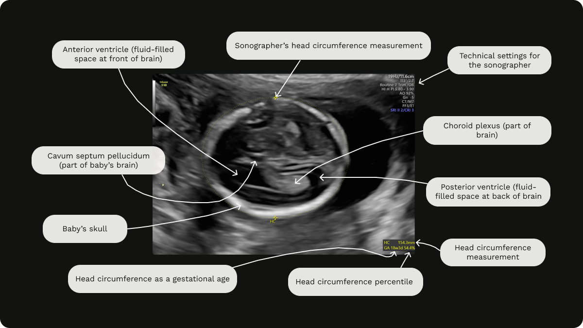 Labelled image of a gender scan at 18 weeks gestation including head circumference (HC) measurement