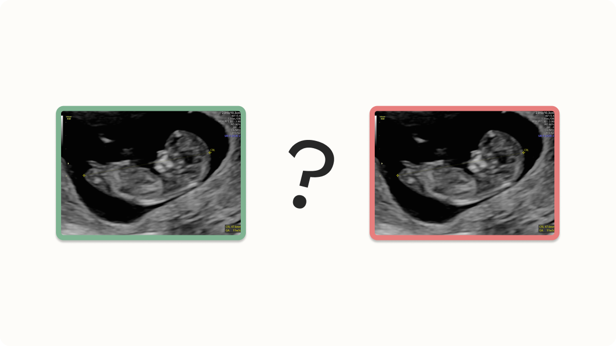 Is this normal? Two ultrasound images to contrast benign ultrasound findings with abnormal findings.