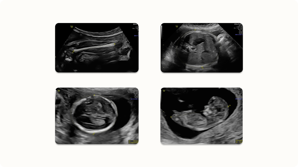 4 pregnancy ultrasound scan images