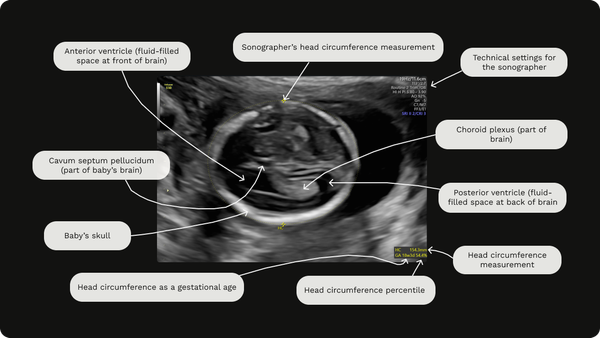 Labelled image of a gender scan at 18 weeks gestation including head circumference (HC) measurement