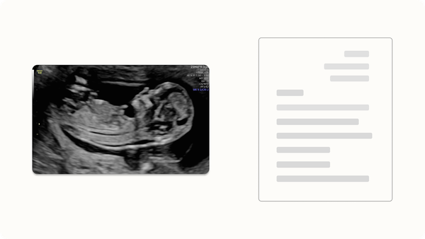 Understanding Your 12-Week NT Scan Results